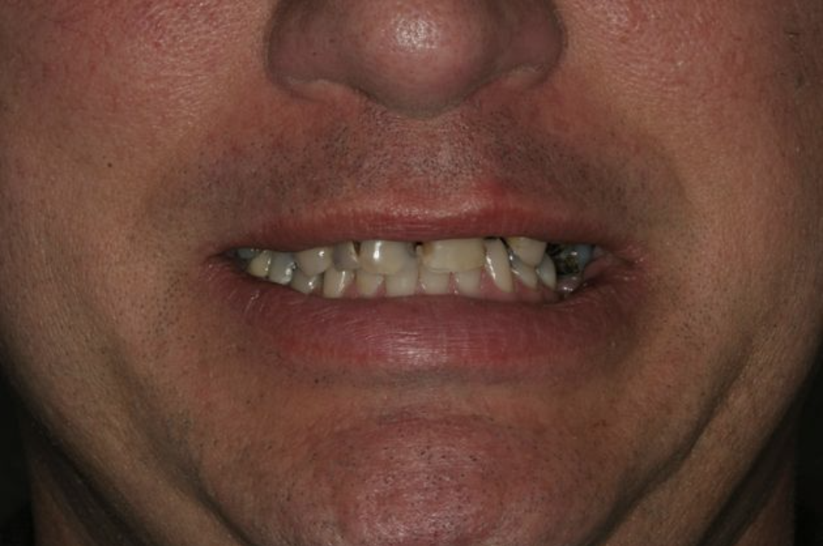 Man's crocked and stained smile before a smile makeover treatment