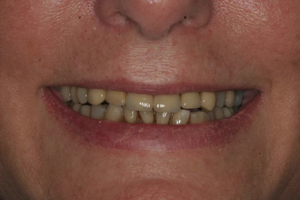 Ridgewood Dental Associates' patient before restorative dentistry