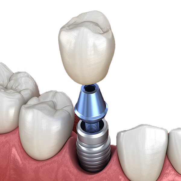 Dental Implant