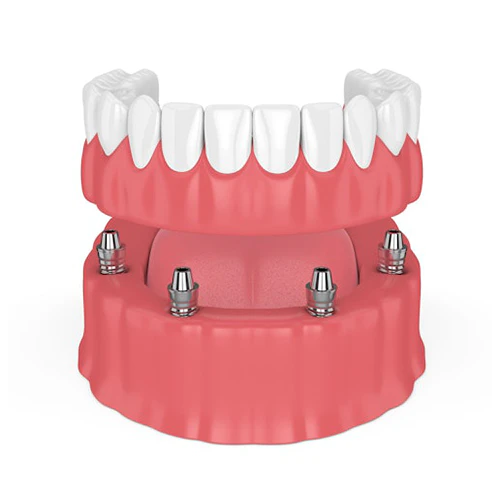 all-on-4 denture