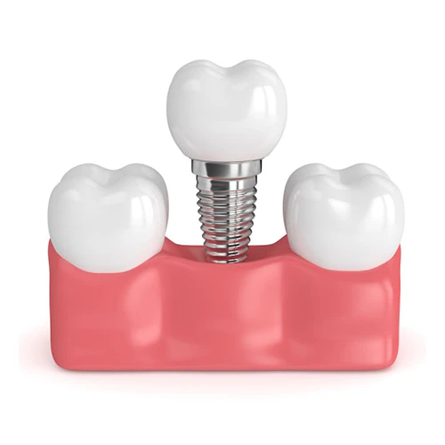 implant-supported crown