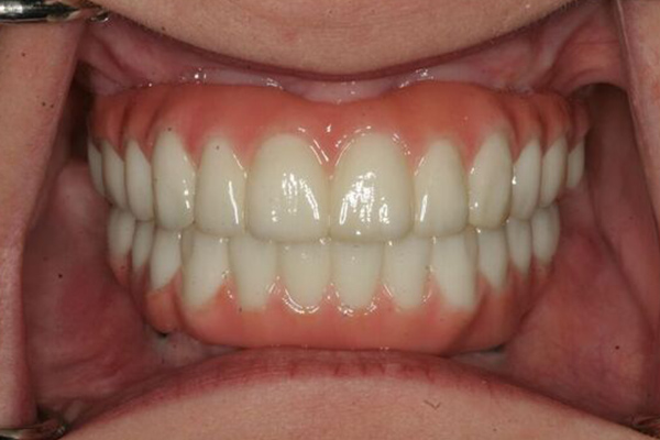 A patient after getting dental implants