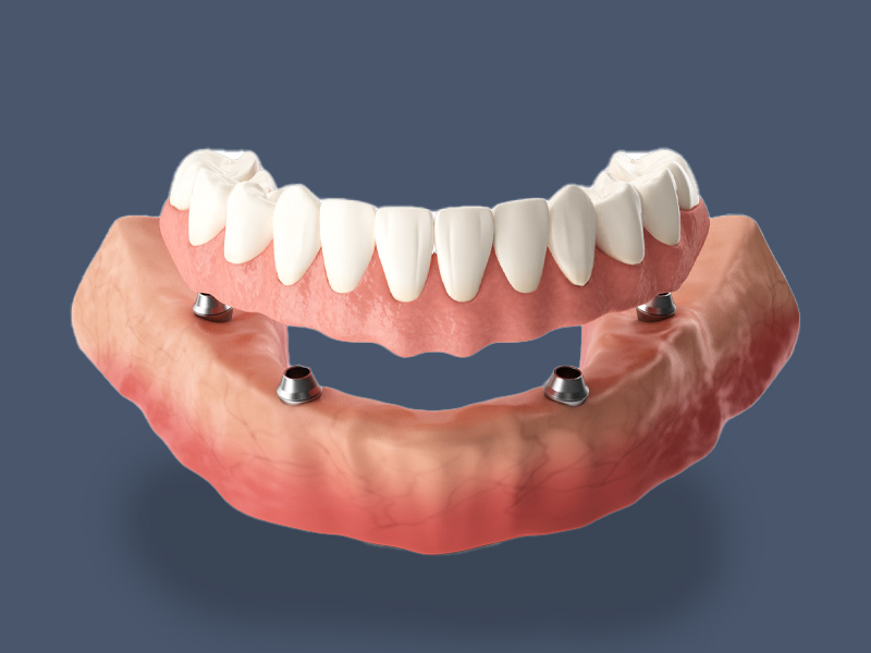 all-on-4 dentures
