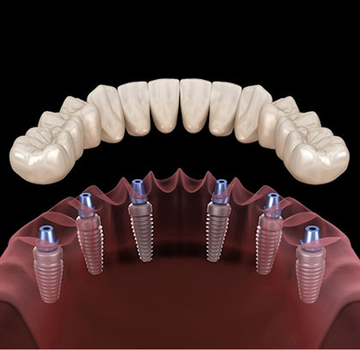 Full Mouth Reconstruction