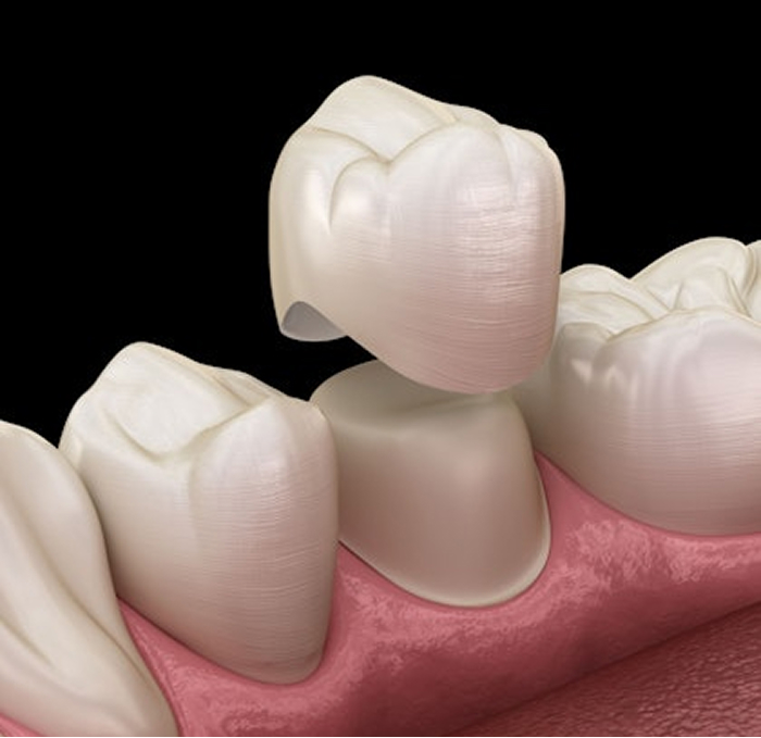 Dental Crowns & Bridges