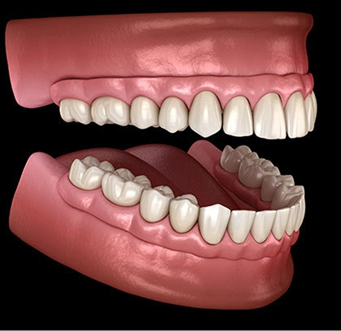 Dentures