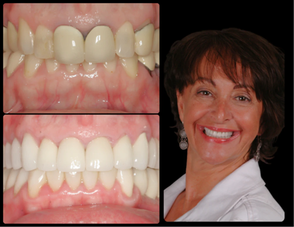 Patient before and after dental implants