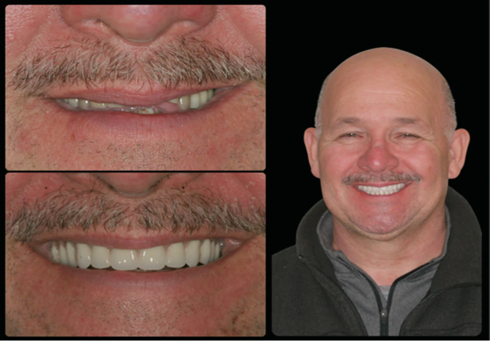 patient before and after dental implants