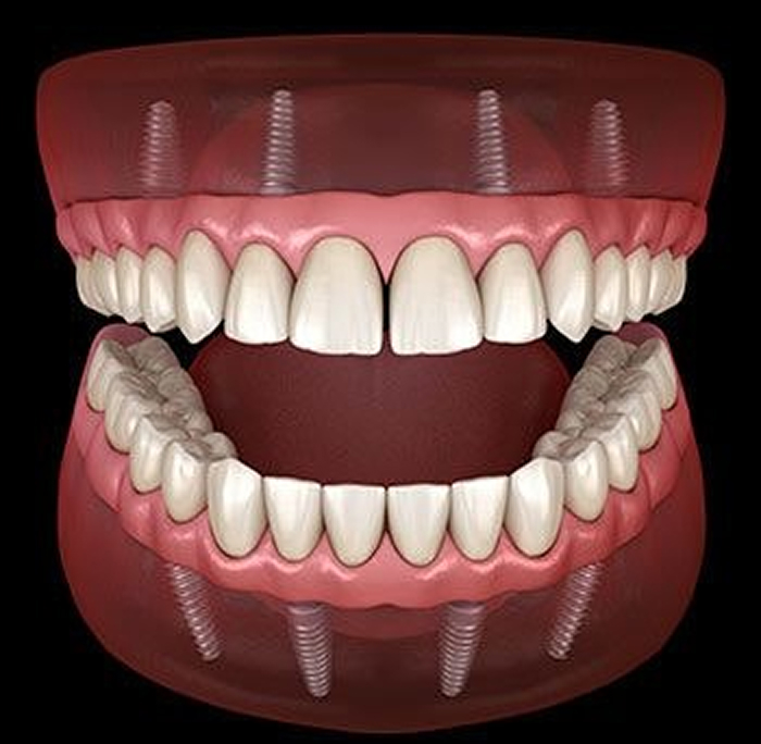 All-on-4 Dental Implants