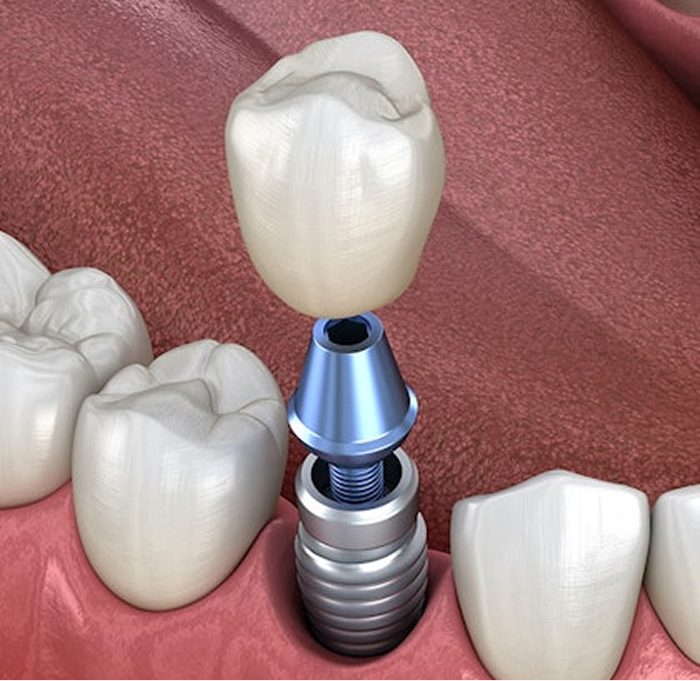 Dental Implants