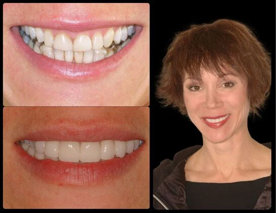 Ridgewood Dental patient before and after implants