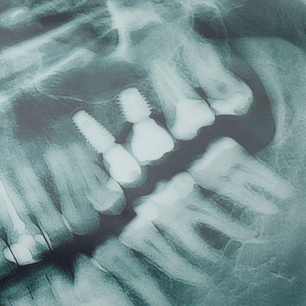 dental implants in an X-ray
