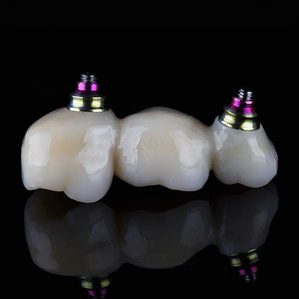 Dental Bridges