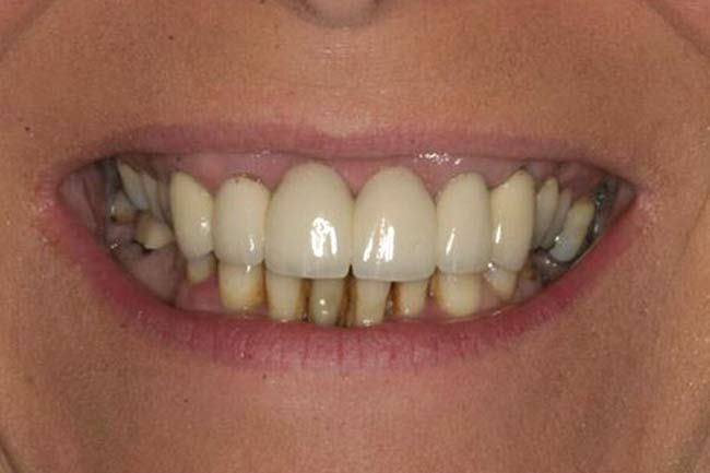 A patient before getting dental implants