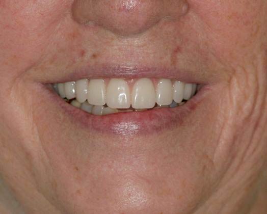 Ridgewood Dental Associates patient after all-on-4