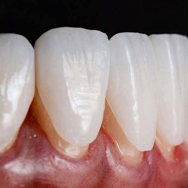 Veneers
