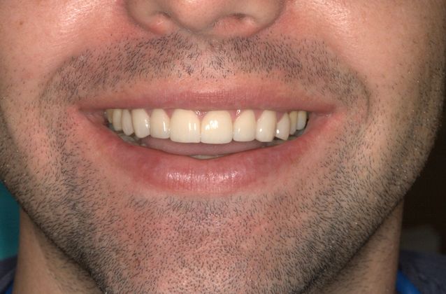 After anterior crowns