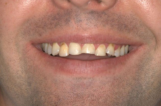 Before anterior crowns