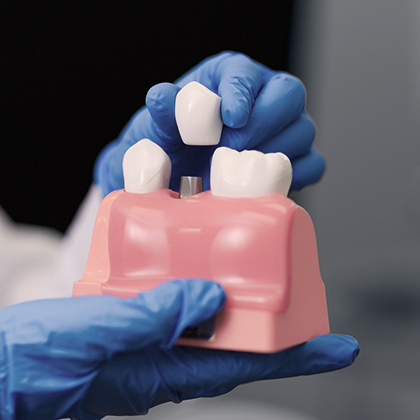 dental crown and three-tooth dental bridge