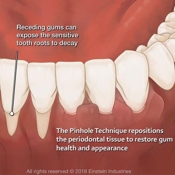 Chao Pinhole® Surgical Technique