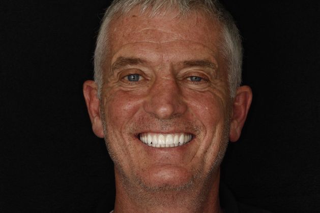 After dental implants photo