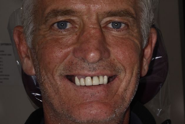 Before dental implants photo