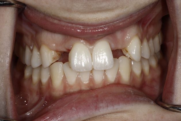 Before dental implants