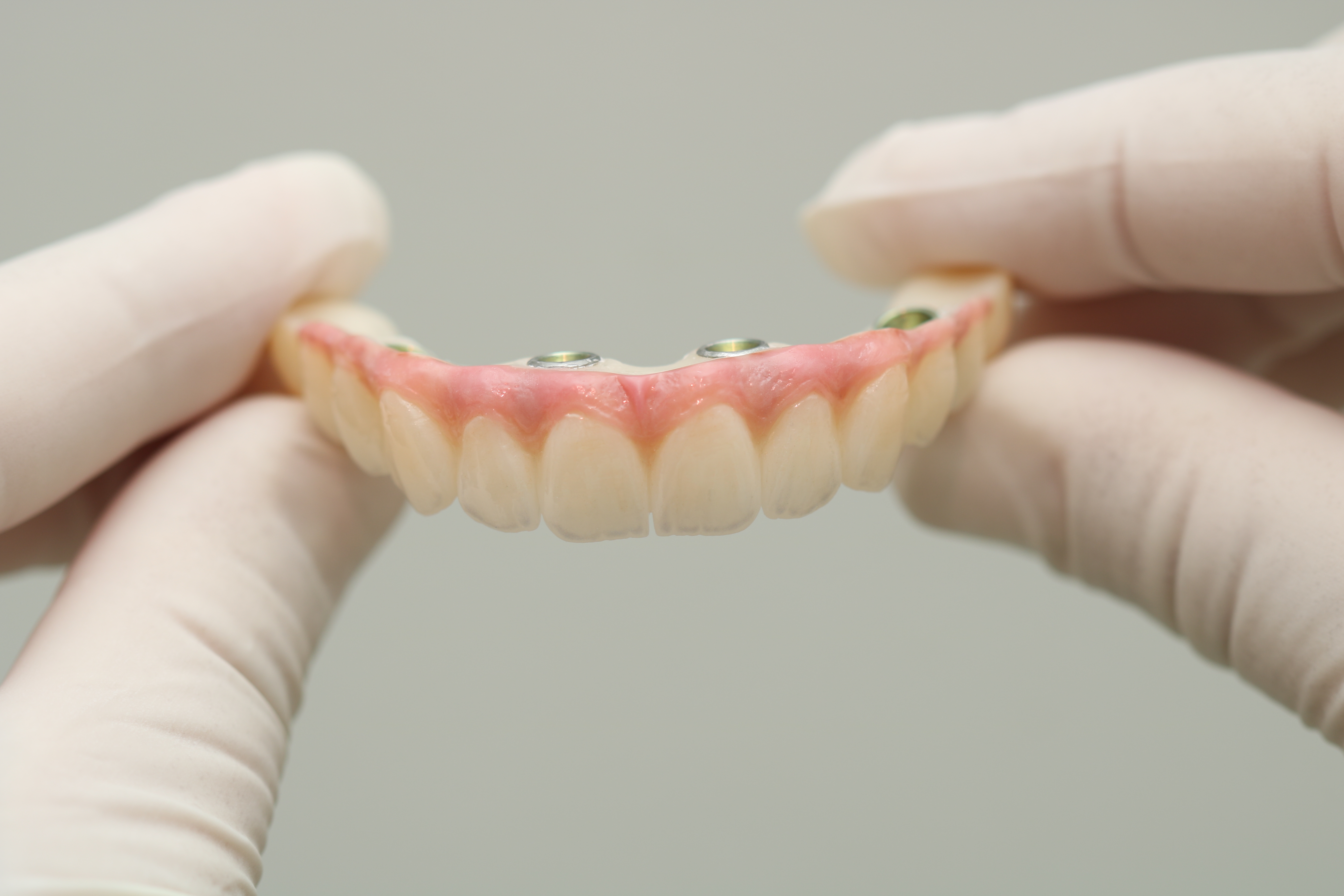All-on-4 implant dentures