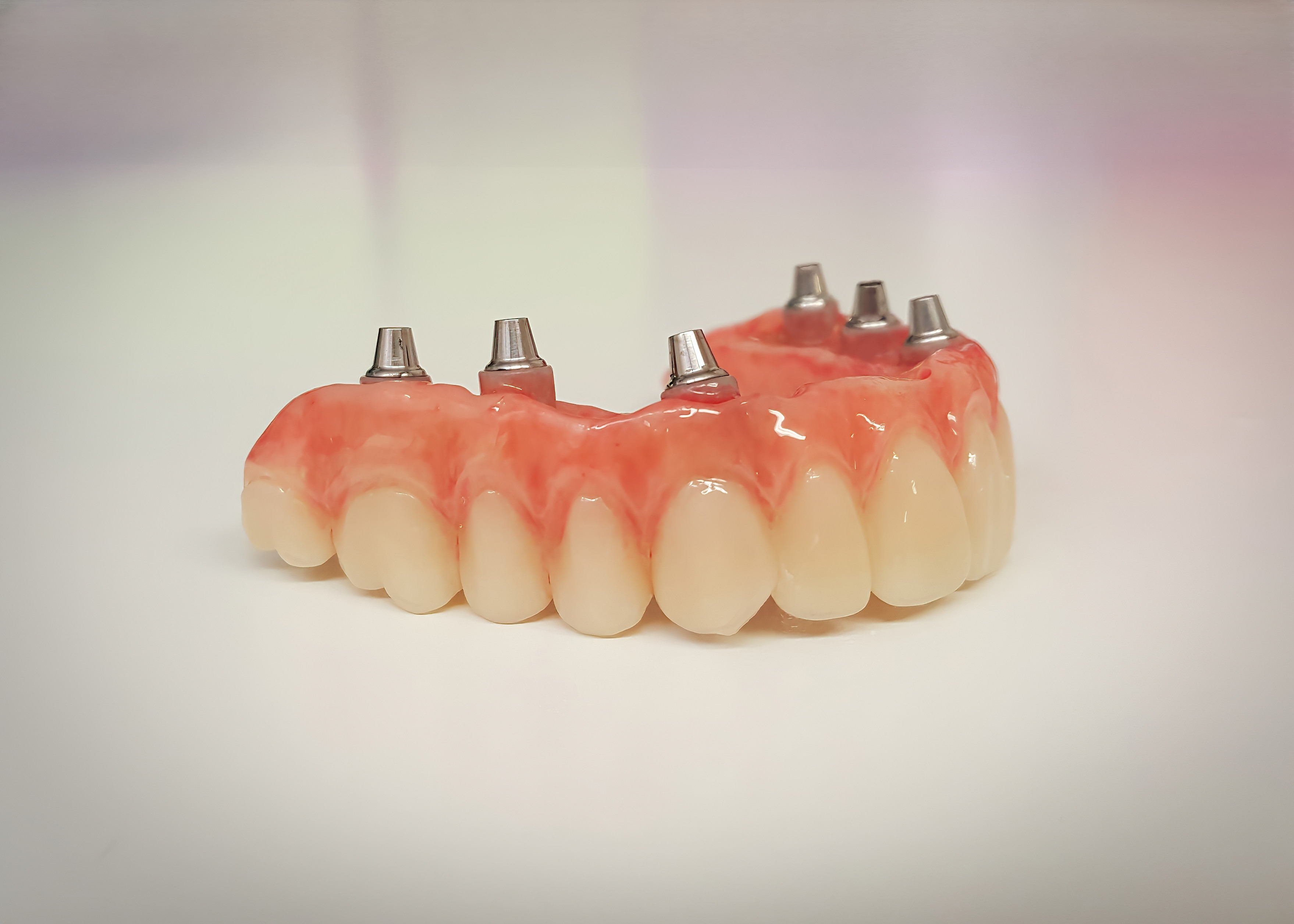 Top-arch denture with six implants