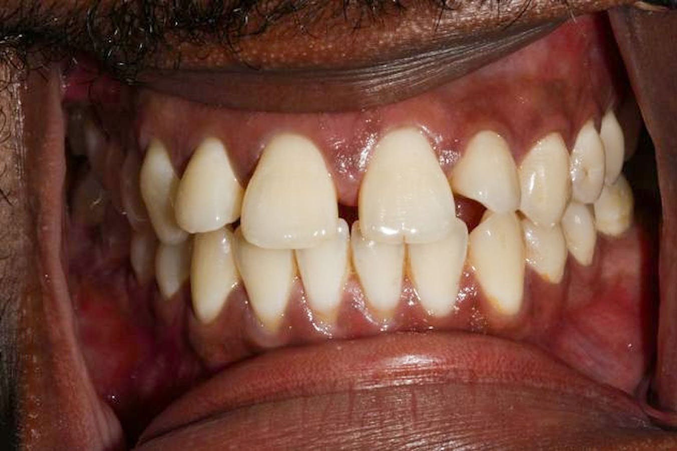 Before Invisalign