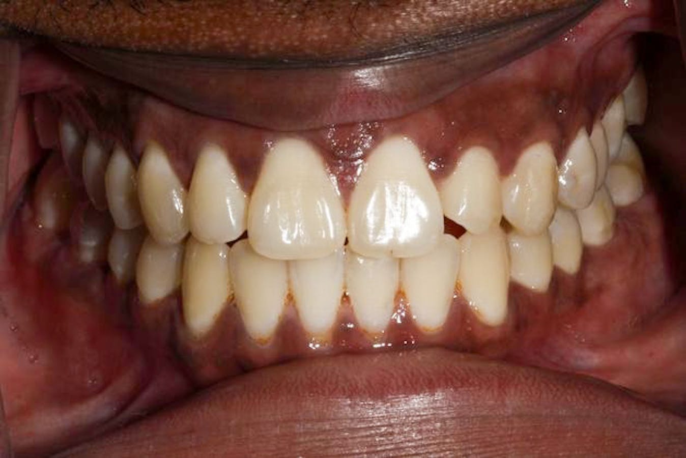 After Invisalign