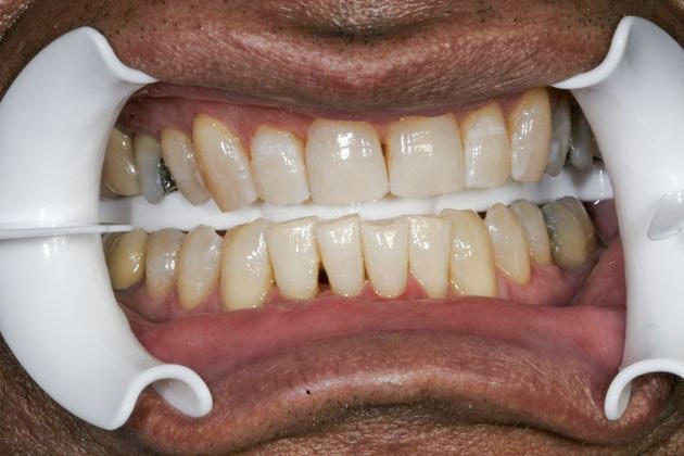 After whitening