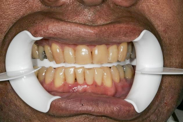 Before whitening