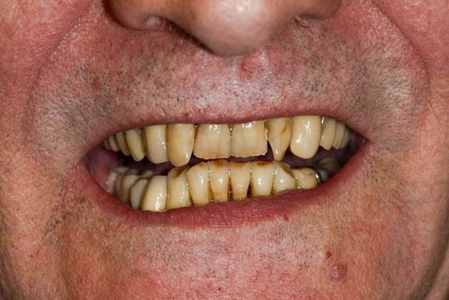 Before full mouth reconstruction