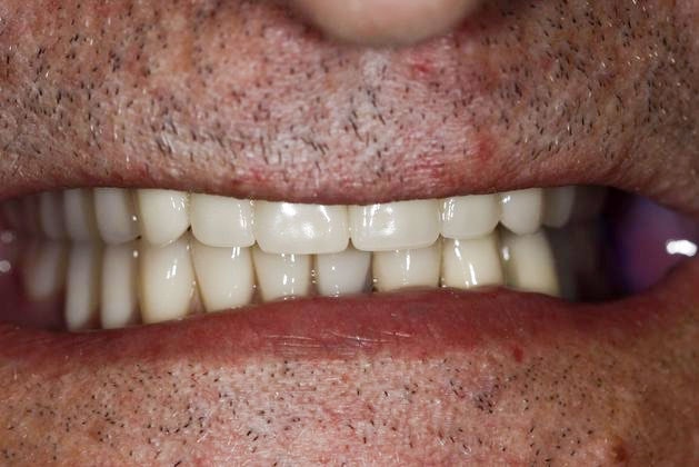 After full mouth reconstruction