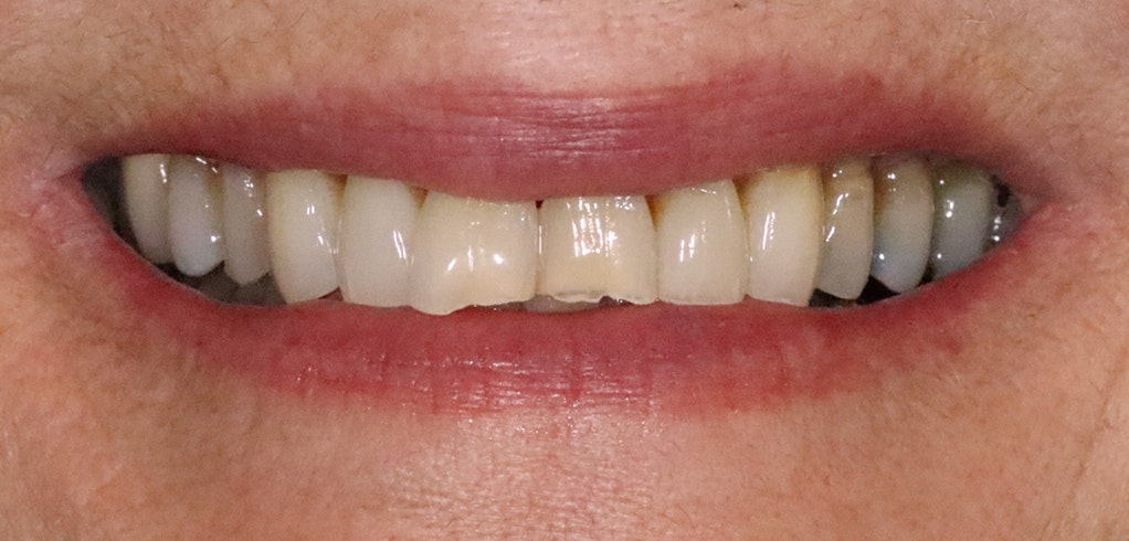 Before dental crowns