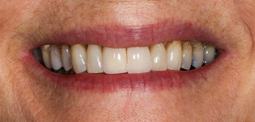 After dental crowns