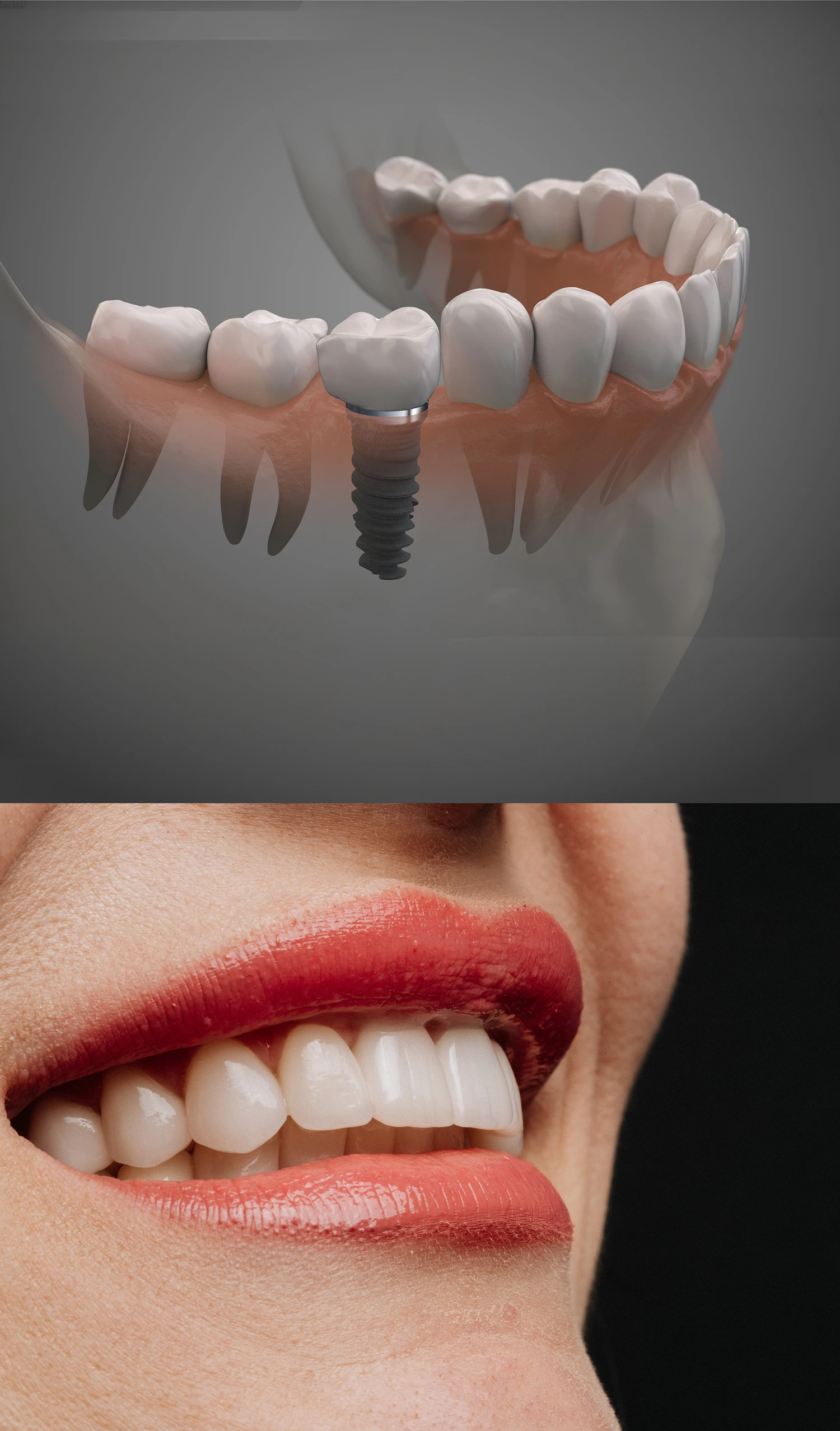 Graphic of dental implant