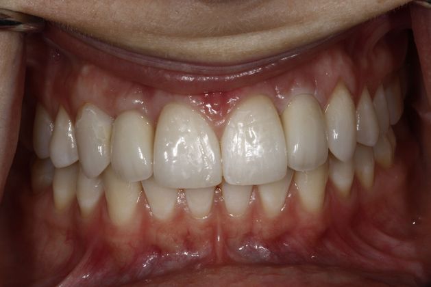 After images if a patient receiving dental implants