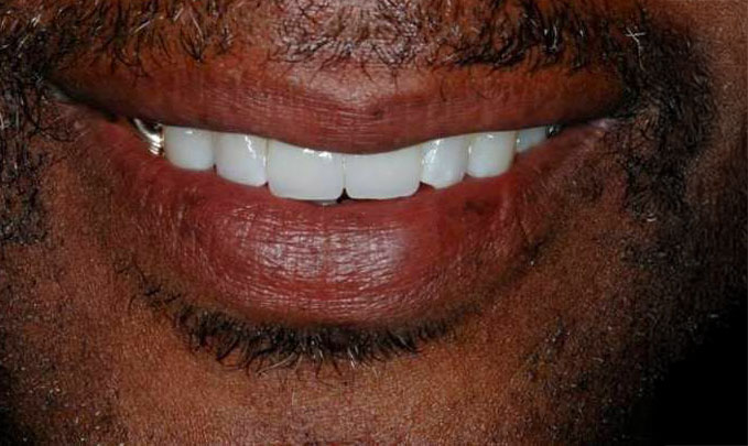 Patient after receiving dental implants