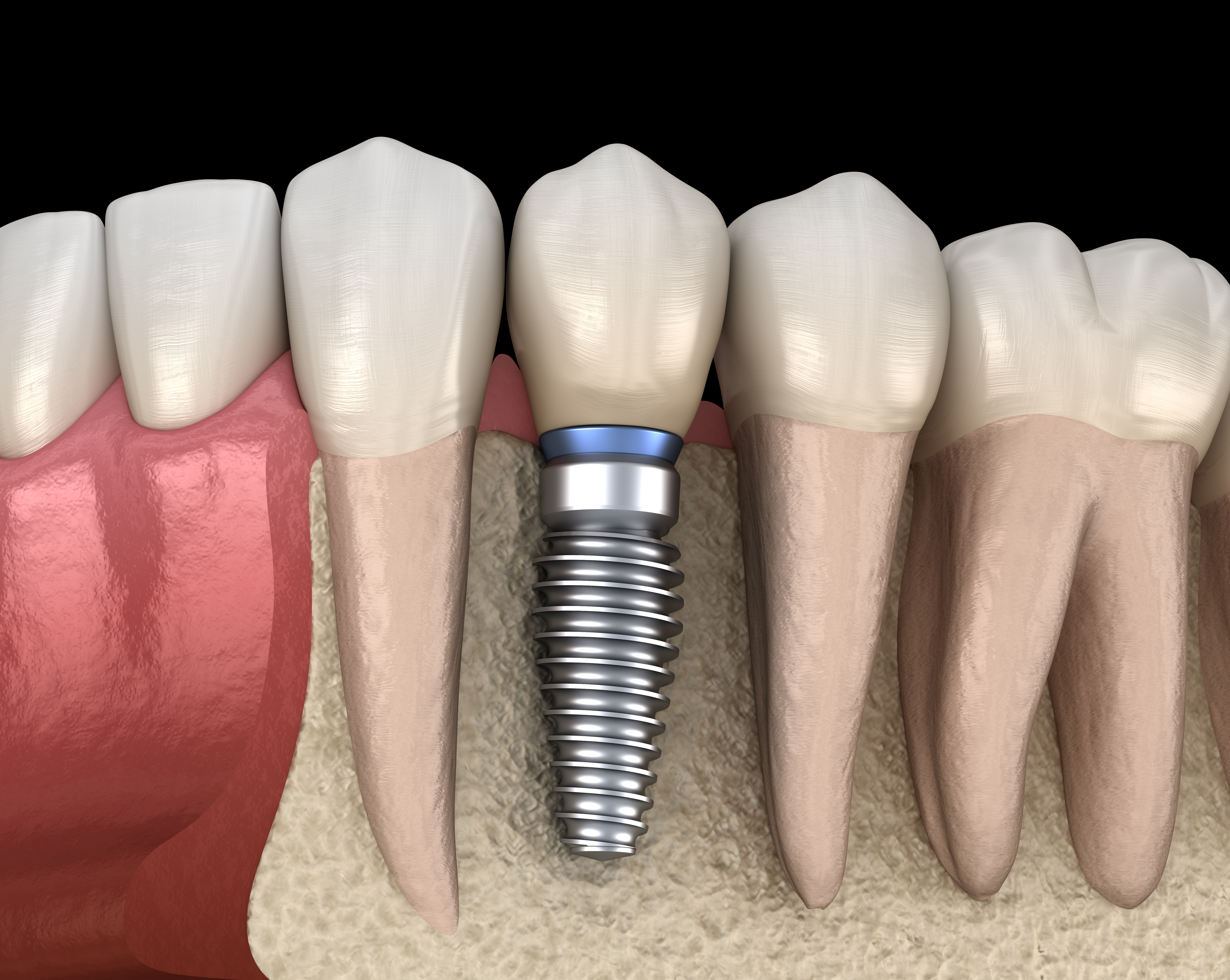 Dental Implants graphic