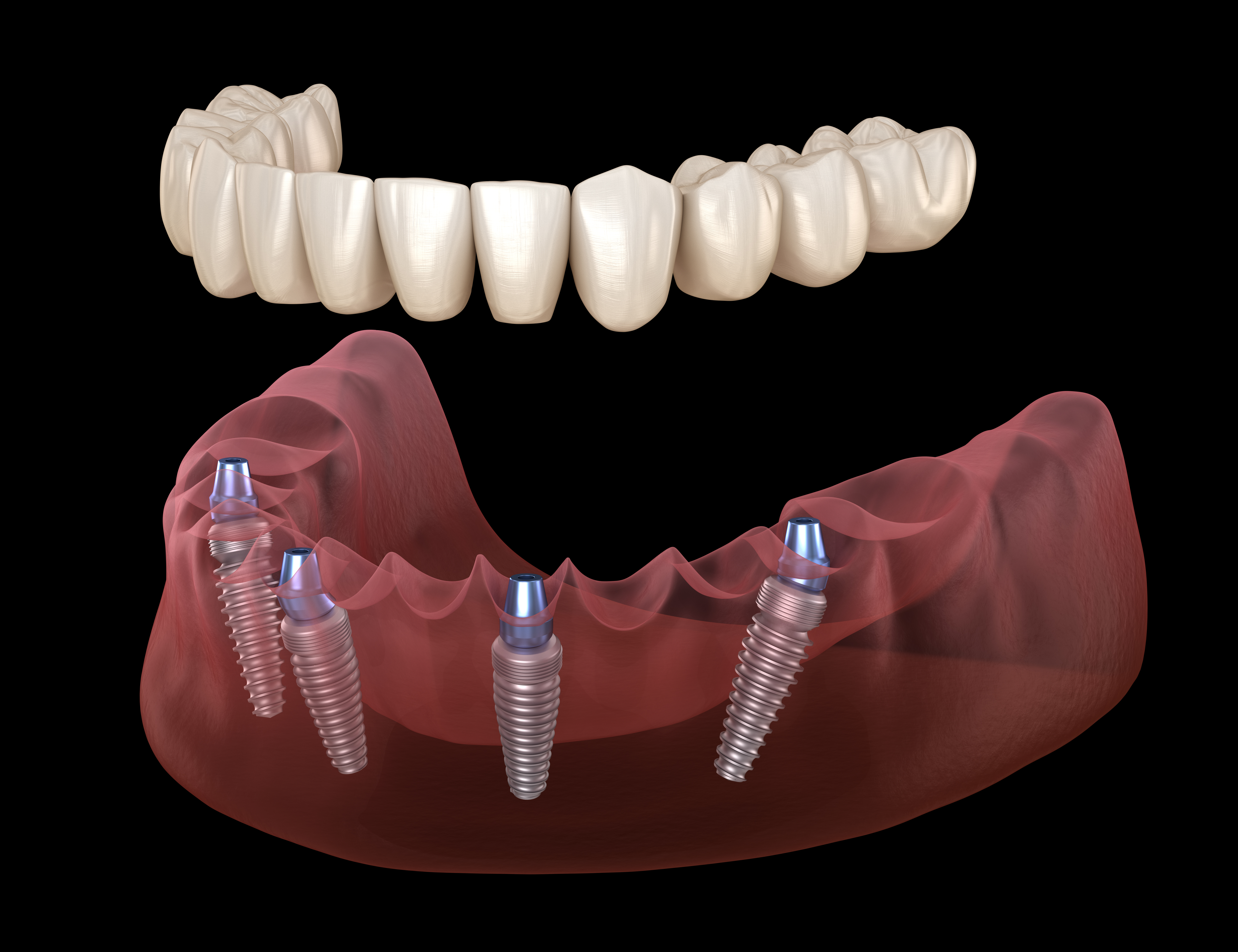 All-on-4 Dental Implants graphic