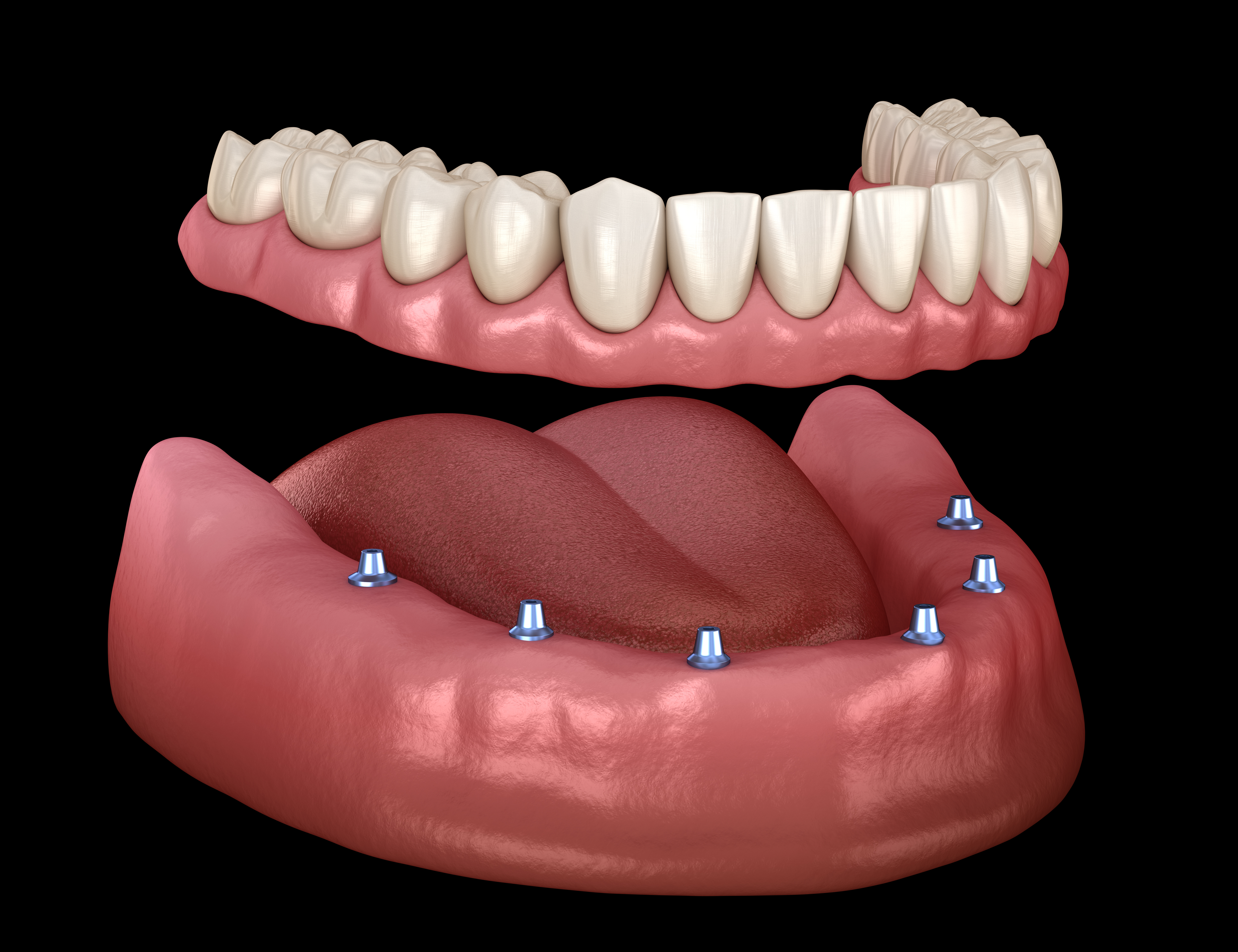 Implant-supported dentures graphic