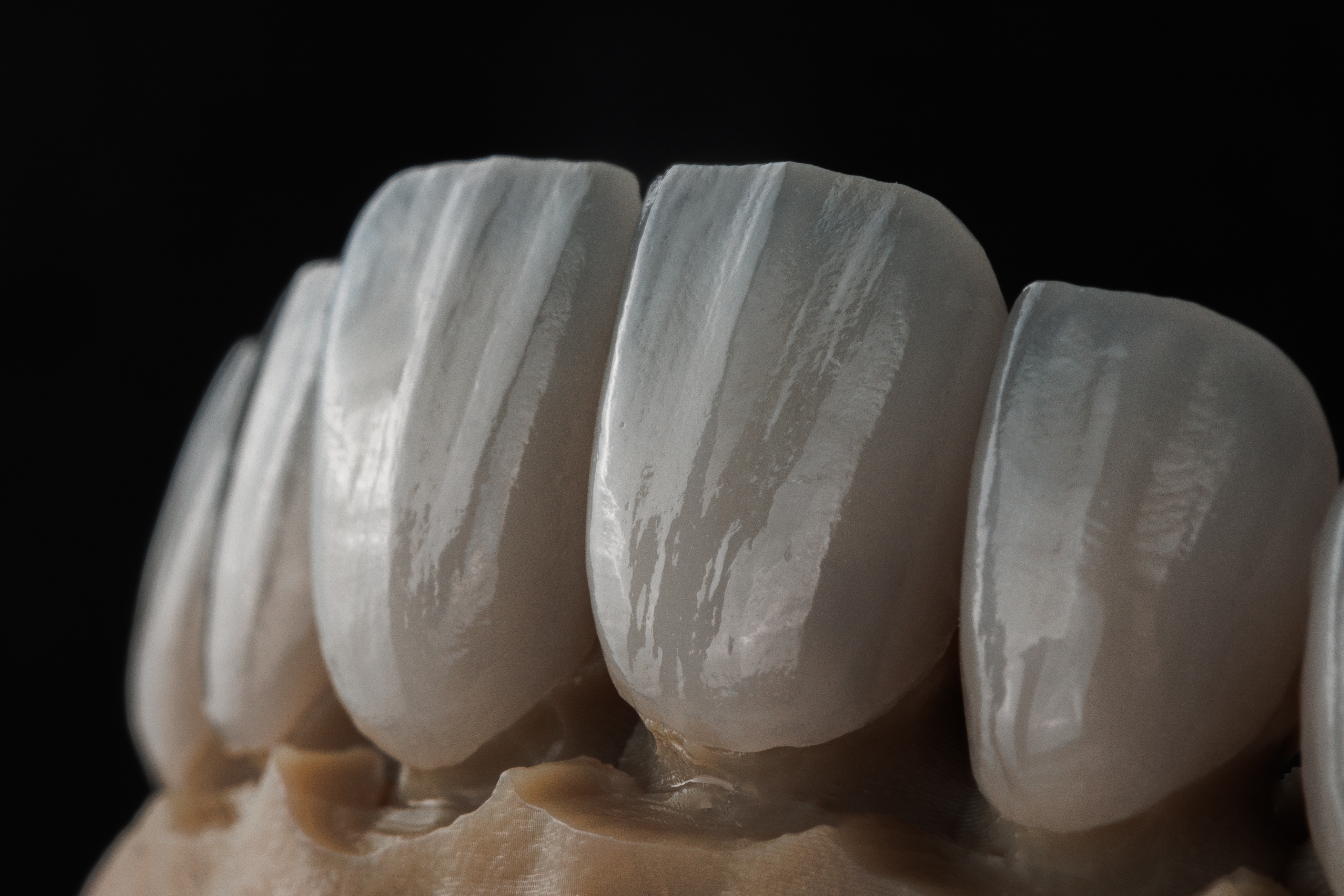 image of veneers