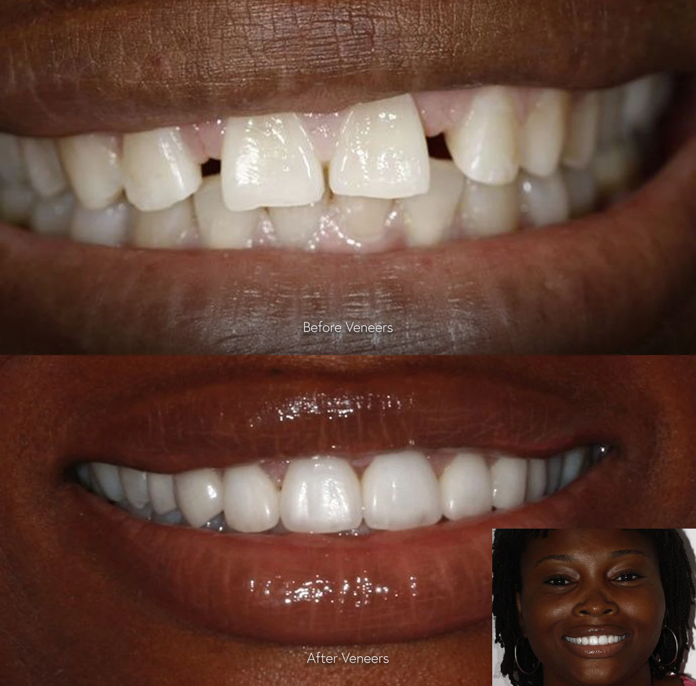 patient before and after veneers