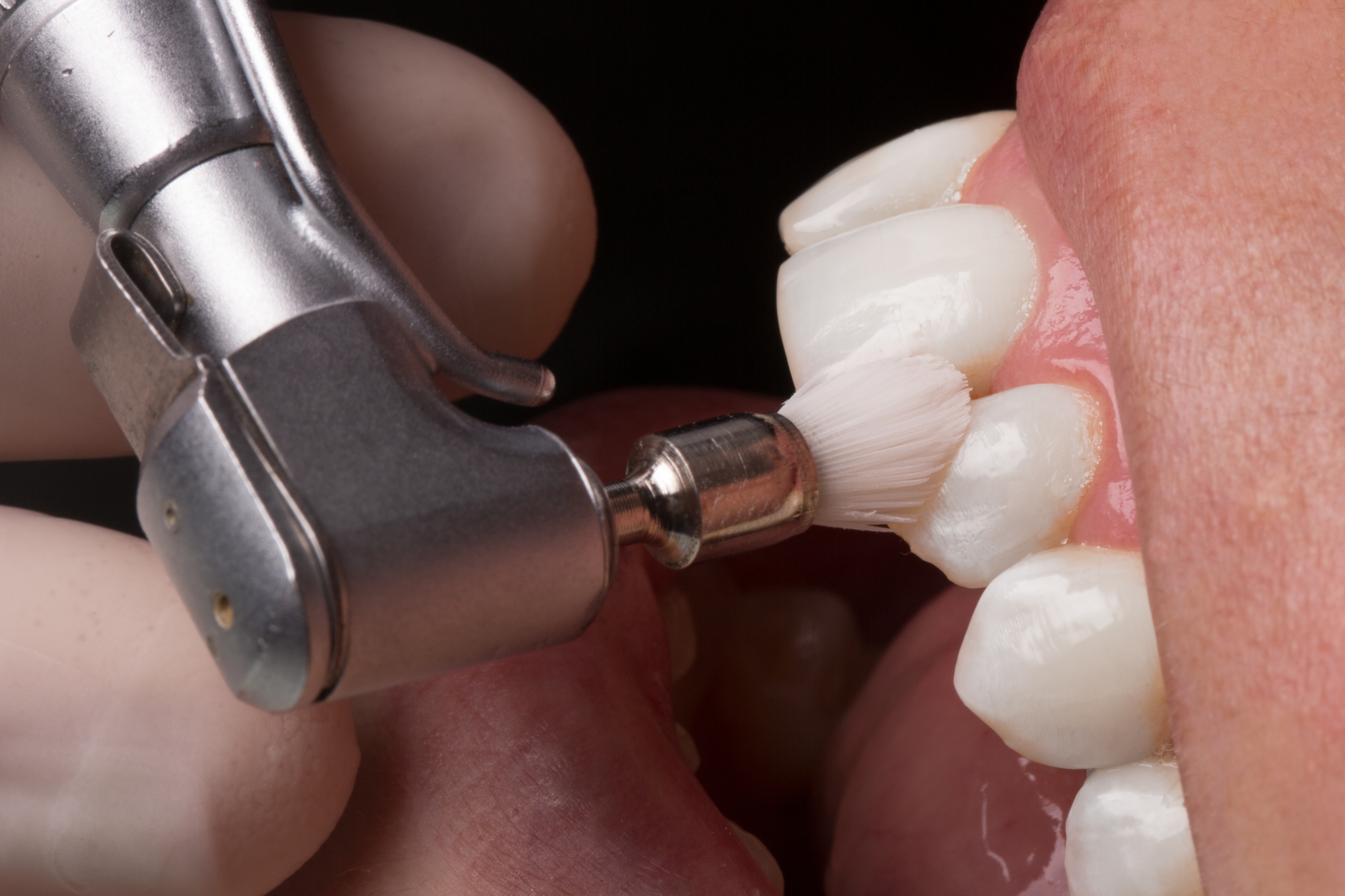 Someone receiving a dental cleaning
