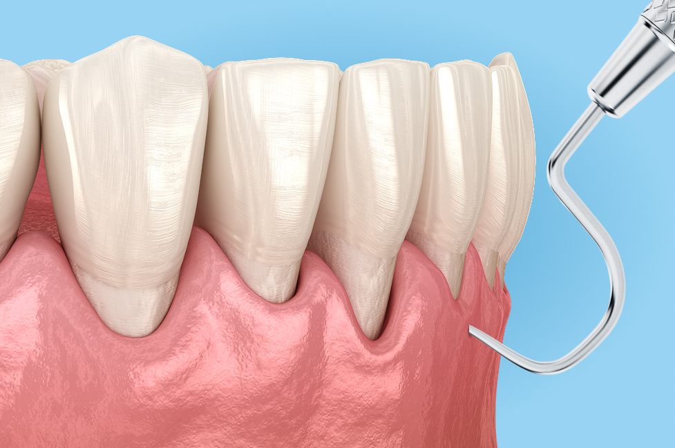 example of the The Chao Pinhole Surgical Technique