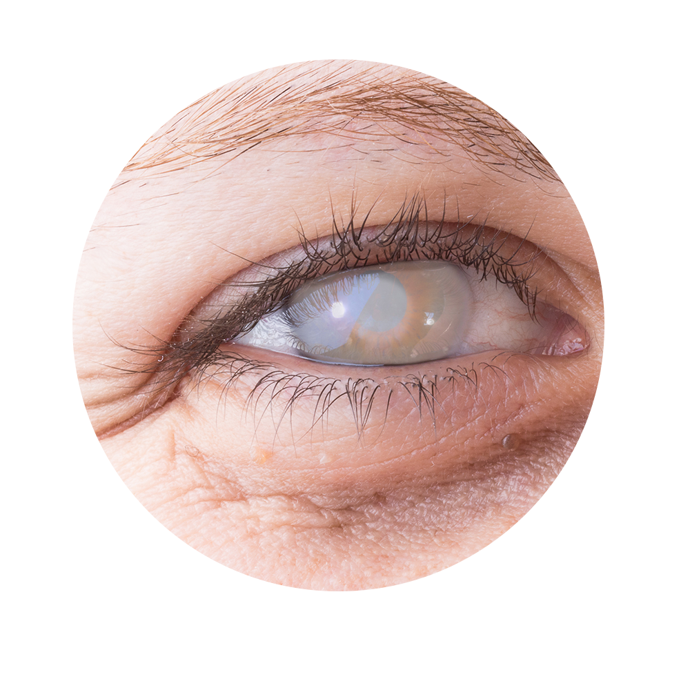 cornea-transplant-dallas-tx-fort-worth-plano-cornea-associates