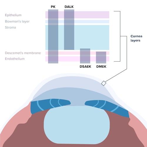 Illustration that shows what each procedure involves different layers of the cornea (PK involves all, DALK involves all except Descemet's membrane and Endothelium, DSAEK involves all except Bowman's layer and Epithelium, and DMEK involves all except Epithelium, Bowman's Layer, and Stroma)
