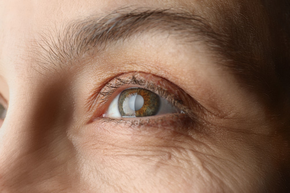 a woman's eye with a cataract